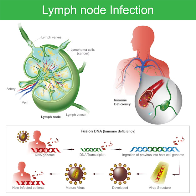 Infographic showing lymph node structure and lymphoma cells