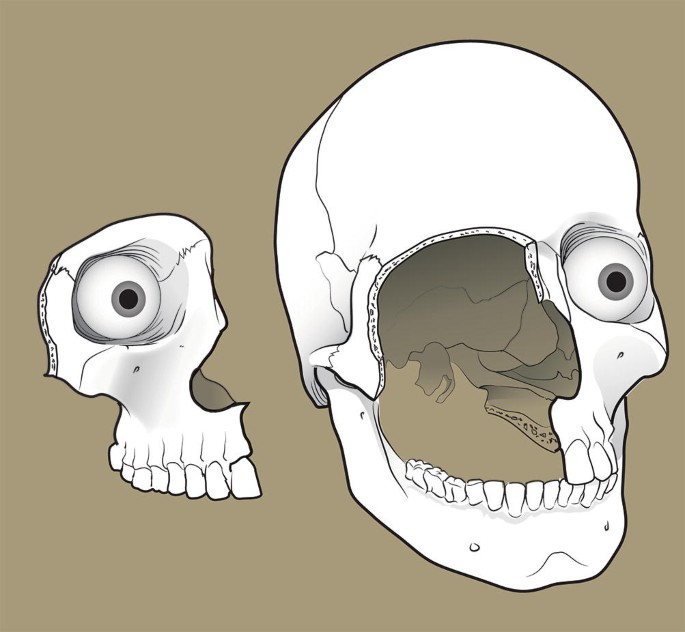 Diagram showing the maxilla and resection area of a maxillectomy