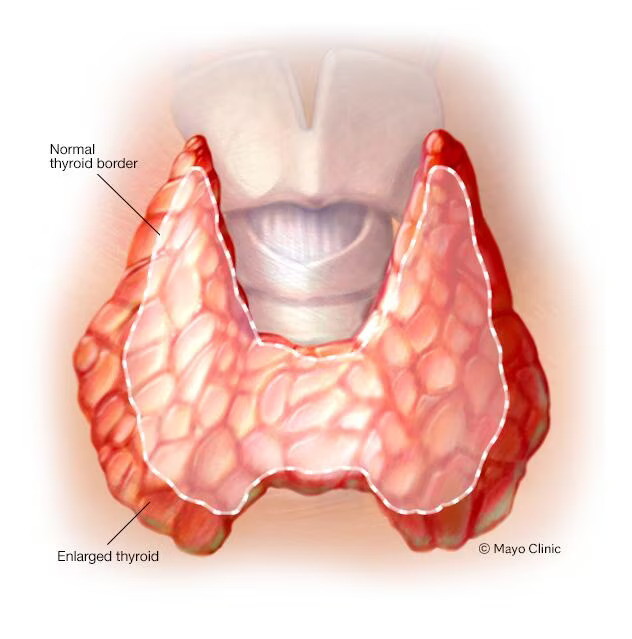 Thyroid cancer in the neck