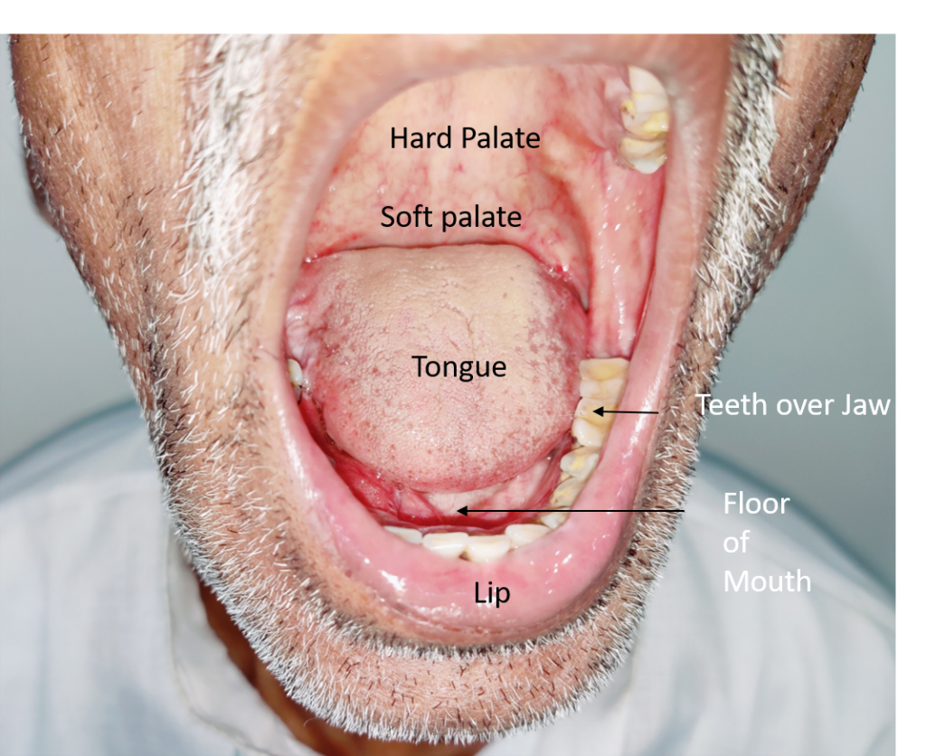 beginning stages of mouth cancer